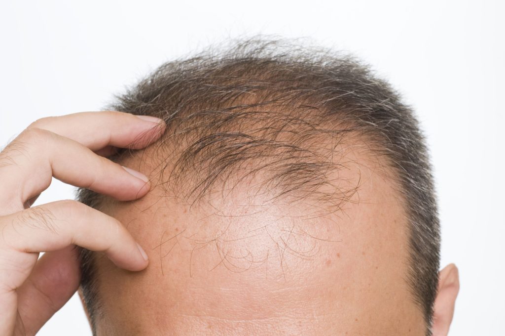 بهترین روش کاشت مو چیست؟