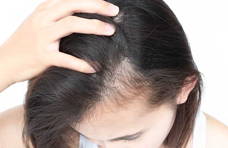 ماینوکسیدیل برای درمان ریزش مو زنان
