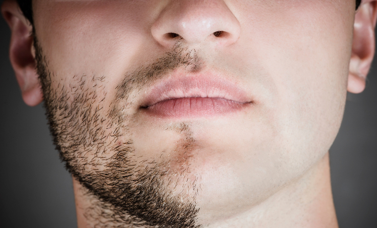 بهداشت و سلامت پوست یکی از مزایای لیزر موهای زائد برای آقایان