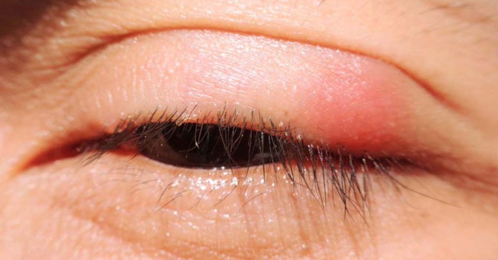 عوارض التهاب پلک چشم یا بلفاریت