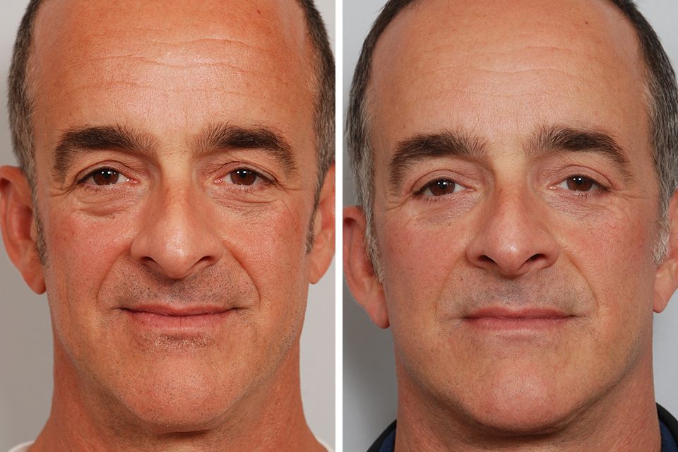 مراقبت های قبل جراحی پلک در مردان