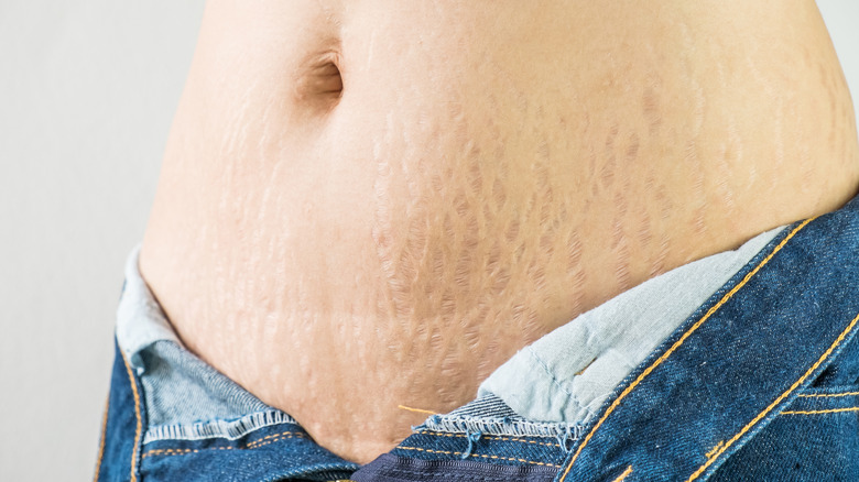 درمان ترک‌های پوستی دوران بلوغ با PRP