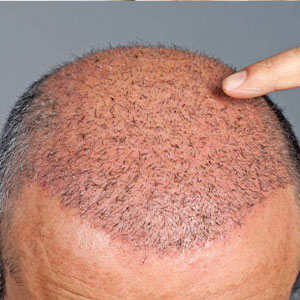 کاشت مو در کلینیک فوق تخصصی پوست و مو