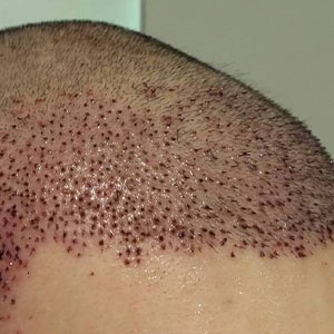 انواع روش کاشت مو در کلینیک مو