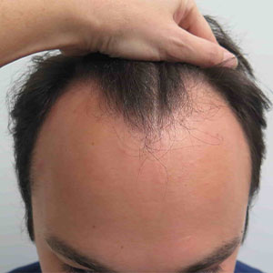 مشخصات مو برای کاشت در کلینیک کاشت مو