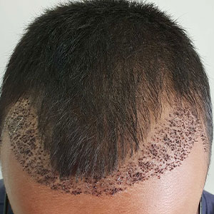 متدهای کاشت مو در کلینیک کاشت مو جردن تهران