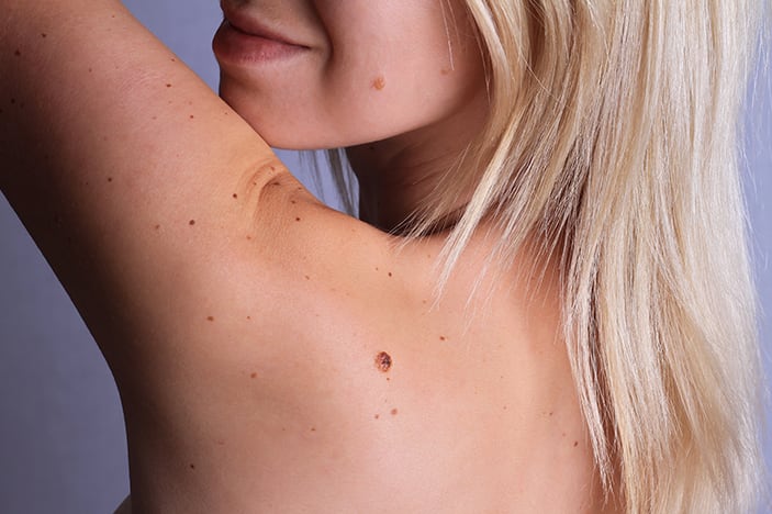 Care after mole removal