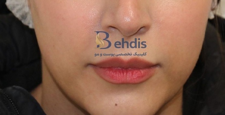 تزریق فیلر بهدیس (1)