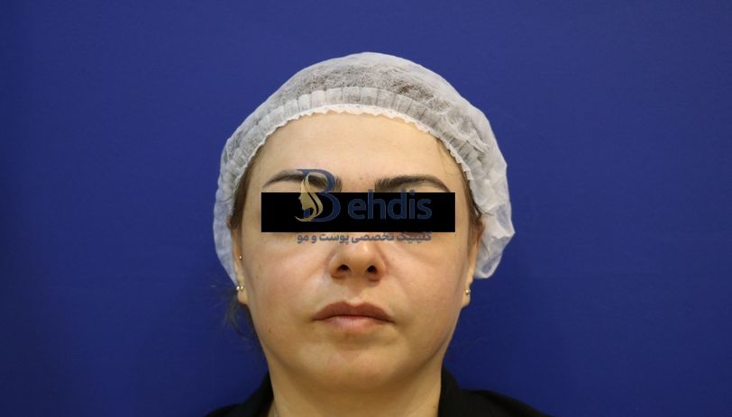 تزریق فیلر بهدیس (2)