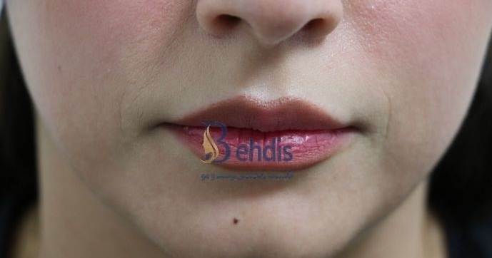 تزریق فیلر بهدیس (3)