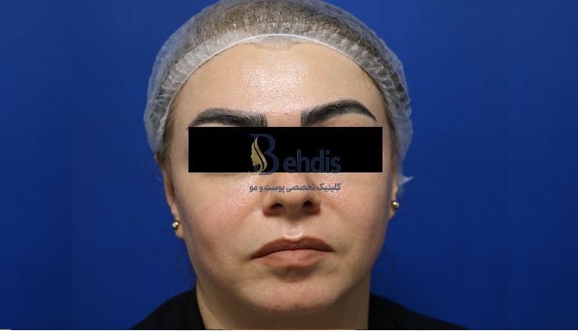 تزریق فیلر بهدیس (5)