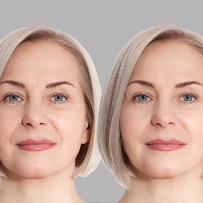 بوتاکس خط خنده