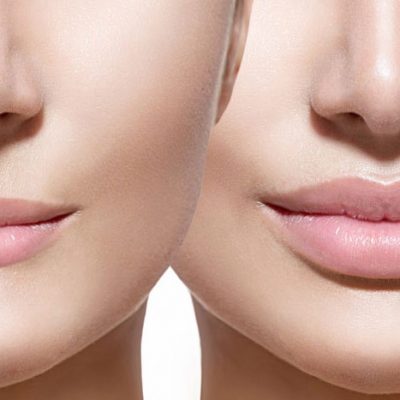 حجم دهی لب با فوتونا