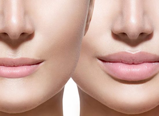 حجم دهی لب با فوتونا