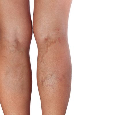 واریس و راه‌ های درمان آن