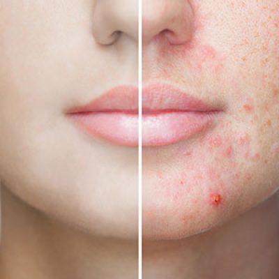 تفاوت لیزر فوتونا با فرکشنال