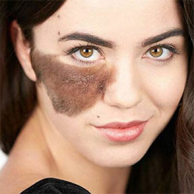 مرکز لیزر ماه گرفتگی در تهران