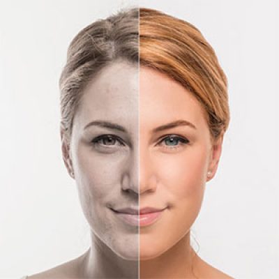 پروفایلو بهتر است یا هایفو؟