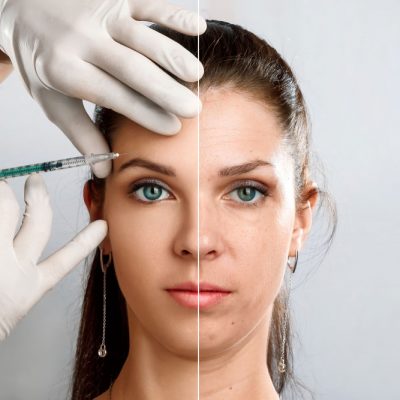 بهترین مکان برای تزریق بوتاکس