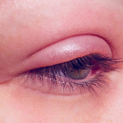 التهاب پلک چشم یا بلفاریت