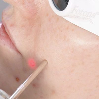 لیزر فوتونا ضد جوش