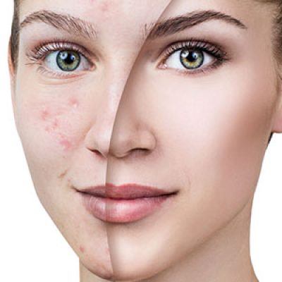 لیزر فوتونا برای لک صورت