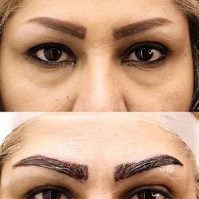 قیمت کاشت ابرو در تهران