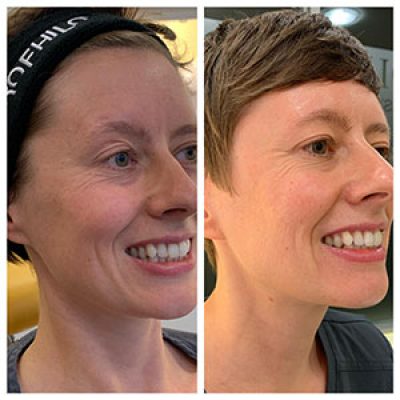 چگونگی تزریق پروفایلو