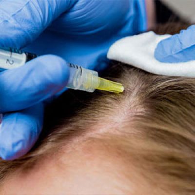 بهترین مزوتراپی مو در تهران