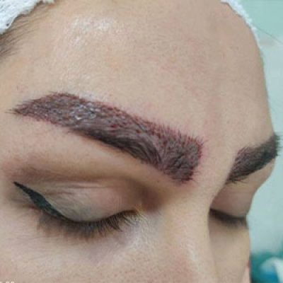 کاشت ابروی طبیعی در تهران