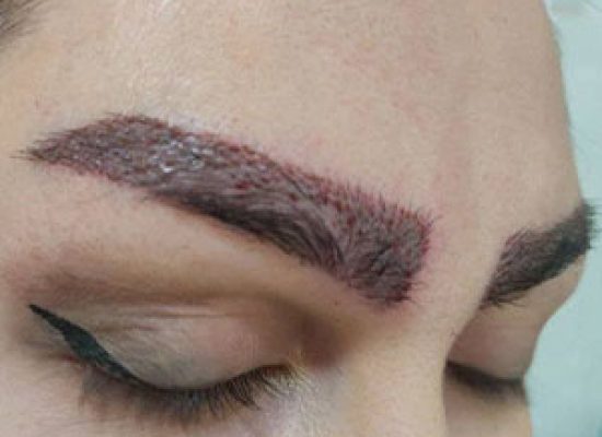 کاشت ابروی طبیعی در تهران