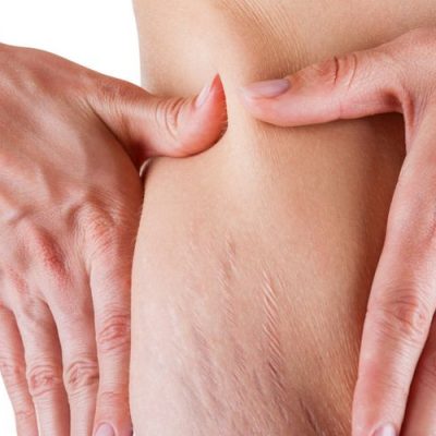 جراحی پلک پایین