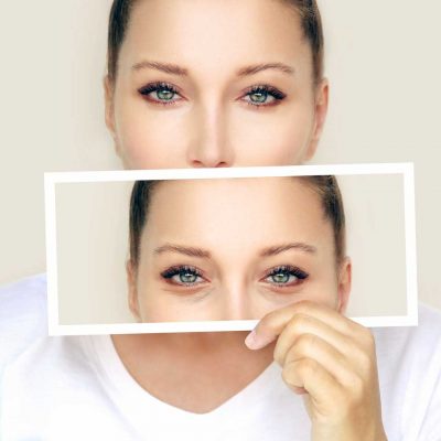 جراحی پلک پایین چشم