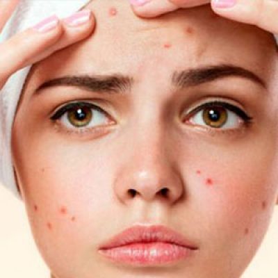 درمان ریزش مو زنان