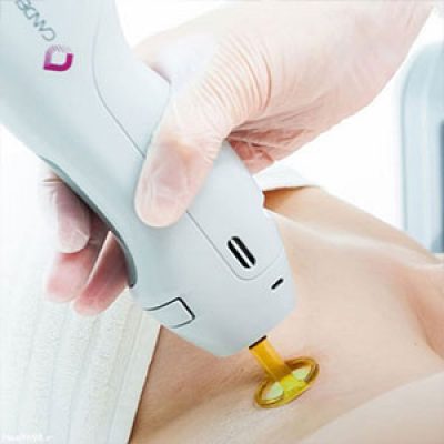 لیزر موهای زائد خطر دارد