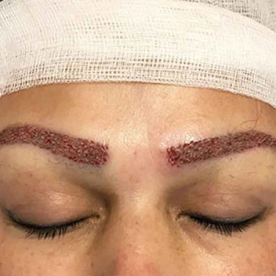 کاشت ابرو به چه صورت است؟