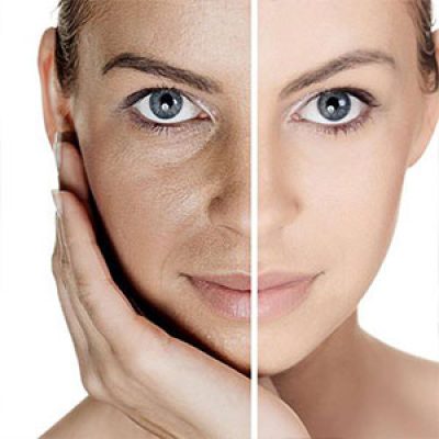 تاثیر پروفایلو روی صورت