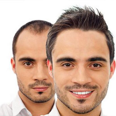 کاشت مو مدرن تهران