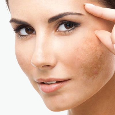 عوارض لیزر فوتونا