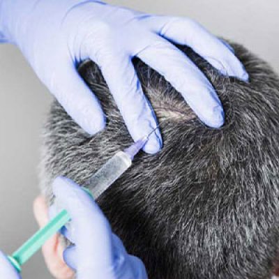 مزوتراپی مو در تهران