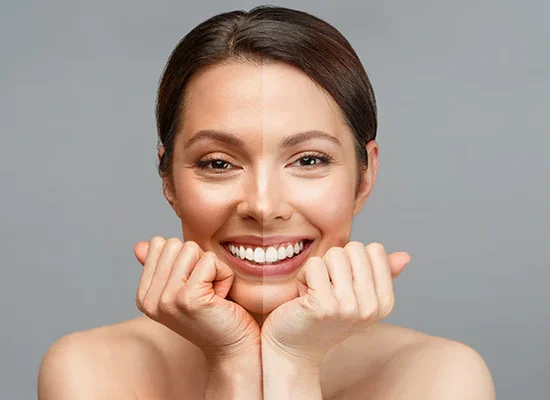 Care after laser whitening and lightening