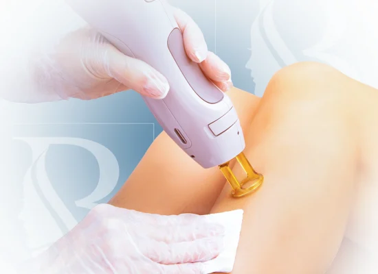 قیمت لیزر موهای زائد