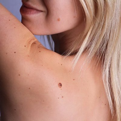 Care after mole removal