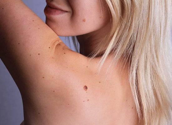 Care after mole removal