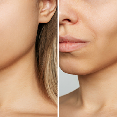 مراقبت پس از بوکال فت