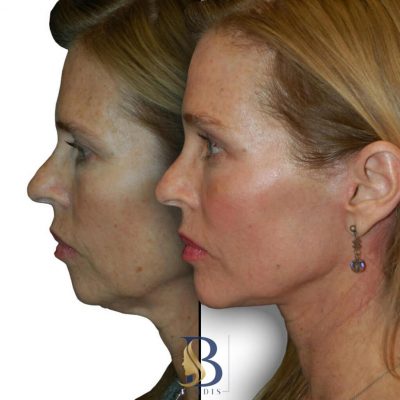 تزریق چربی به گونه